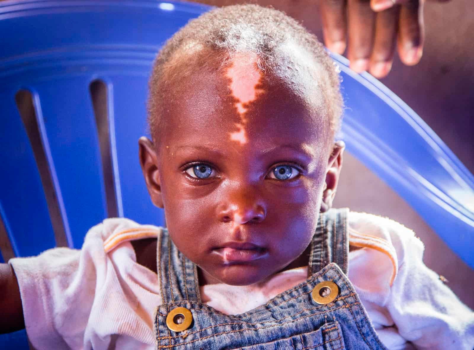 Le syndrome de Waardenburg - noirs aux yeux bleus